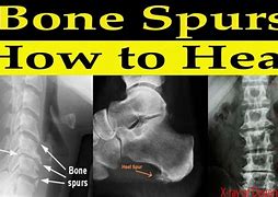 Image result for Bone Spurs in Arches Removal