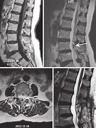 Image result for Lumbar Spine Cancer