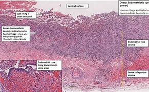 Image result for Endometriotic Cyst Histology