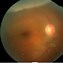 Image result for Retinal Tear Fundus