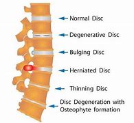 Image result for Spinal Disc Problems