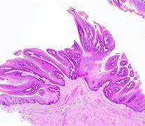 Image result for Nasal Squamous Papilloma