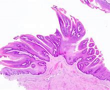 Image result for Papilloma Removal