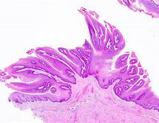 Image result for Squamous Cell Papilloma Uvula
