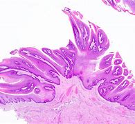 Image result for Squamous Papilloma Oral Lesion