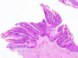 Image result for Squamous Papilomas