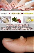 Image result for How to Treat Warts On Hands