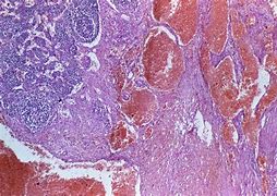 Image result for Kaposi Sarcoma Rash