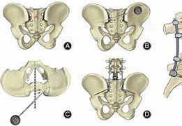 Image result for Picture of an Awl and a Tap in Spine Screw Placement