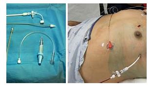 Image result for Chest Tube Pigtail Drain