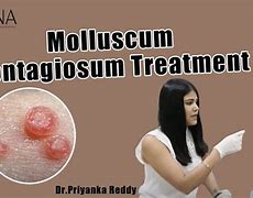 Image result for Treating Molluscum