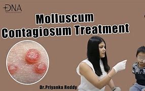 Image result for Molluscum Contagiosum Rash Treatment