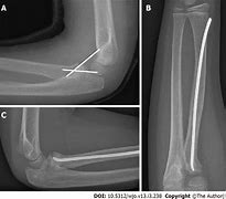 Image result for Radial Neck Fracture