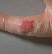 Image result for Cancer Skin Conditions