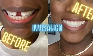 Image result for Before and After Pics People Who Use Byte to Fix Teeth