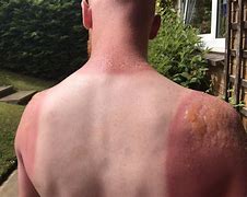 Image result for severe sunburn symptoms