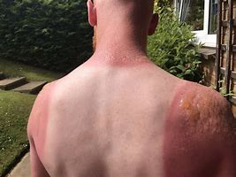 Image result for Sun Burn Skin Severe