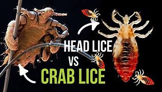 Image result for Crabs vs Lice