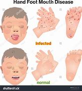 Image result for Hand Foot Mouth Disease Symptoms Kids