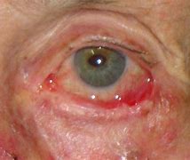 Image result for Lump On Lower Eyelid