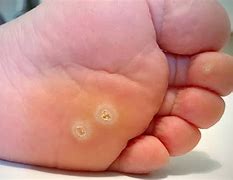 Image result for Foot Common Wart Removal