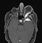 Image result for Meningioma Brain MRI