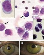 Image result for Mycosis Fungoides Eye