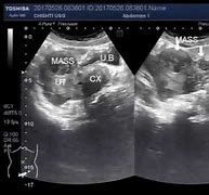 Image result for Multi Fibroid Uterus