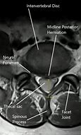 Image result for Lumbar MRI Anatomy