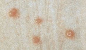 Image result for Molluscum Contagiosum Dark Skin
