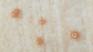 Image result for Molluscum Contagiosum Black