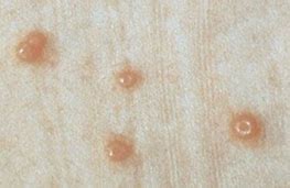Image result for Molluscum Contagiosum On Genital Area