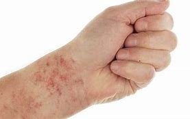 Image result for chlamydial rashes signs
