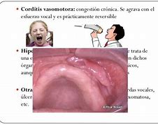 Image result for corditis