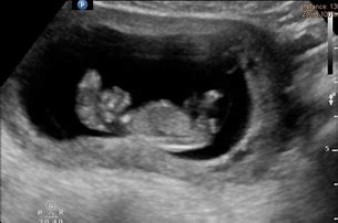 Image result for Anencephaly Ultrasound 12 Weeks