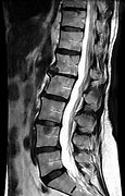 Image result for MRI for Lumbar Spine