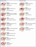 Image result for Open Skin Lesion