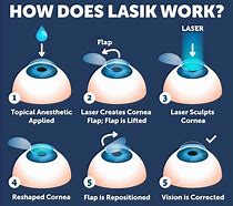 Image result for Lasik Operation