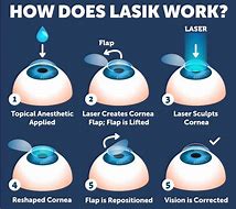Image result for Lasik