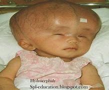 Image result for Hydrocephaly