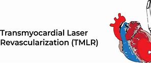 Image result for Transmyocardial Laser Revascularization
