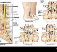 Image result for Lumbar Spine L4 and L5