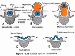 Image result for Rachischisis of Spinal Cord