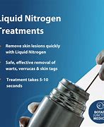 Image result for Molluscum Contagiosum Liquid Nitrogen Treatment