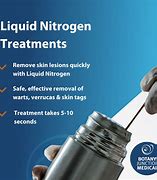 Image result for Home Liquid Nitrogen Wart Removal