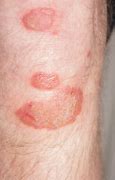 Image result for Red Blotches On Skin