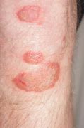 Image result for Large Red Spots On Skin