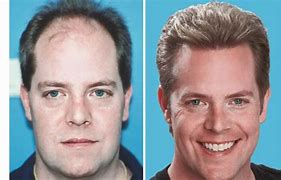 Image result for Amazing Hair Transplant