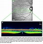 Image result for Retina Blood Vessels Eye