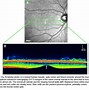 Image result for Basics of Fundus Retina Drawing